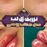 تعدادی مدل جهت ترزیق ژل و بوتاکس نیازمندیم