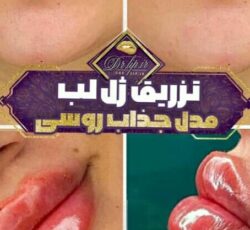 تعدادی مدل جهت ترزیق ژل و بوتاکس نیازمندیم