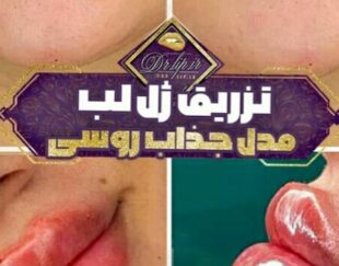 تعدادی مدل جهت ترزیق ژل و بوتاکس نیازمندیم