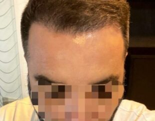 کاشت مو ،ابرو،لاغری موضعی