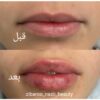 تزریق ژل و بوتاکس با کمترین قیمت