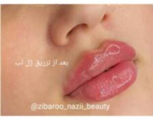 تزریق ژل و بوتاکس با کمترین قیمت