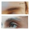 اپلاسیون حرفه ای و تخصصی