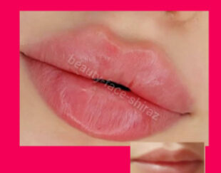 آموزش وخدمات ژل،بوتاکس،نخ،لیزر،کلینیک