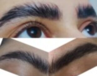 اپلاسیون حرفه ای و تخصصی