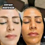لیزر و کارهای پوستی