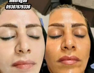 لیزر و کارهای پوستی