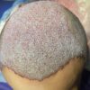 کاشت مو به روش میکروگرفت با جدیدترین متد روز و پی ارپی
