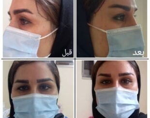 لیفت صورت گونه ابرو شقیقه سانترال