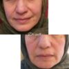 طب سوزنی درمانی و زیبایی