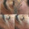 طب سوزنی درمانی و زیبایی