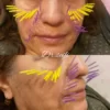 طب سوزنی درمانی و زیبایی