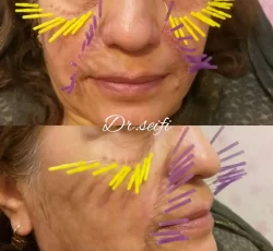 طب سوزنی درمانی و زیبایی