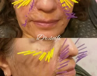 طب سوزنی درمانی و زیبایی