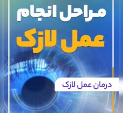 عمل لازک و لیزیک و prk