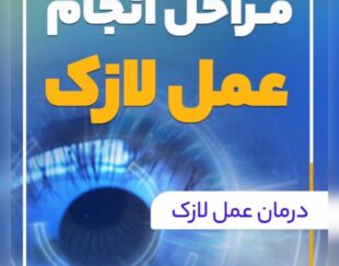 عمل لازک و لیزیک و prk