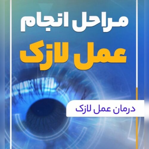 عمل لازک و لیزیک و prk