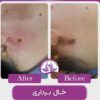 لیزر موهای زائد بدن بانوان و اقایان
