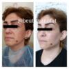 تزریق چربی توسط پزشک