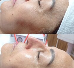 فیشال و پاکسازی پوست