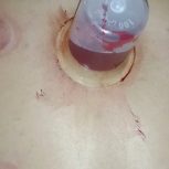 حجامت بادکش سم زدایی