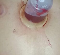 حجامت بادکش سم زدایی