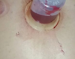 حجامت بادکش سم زدایی