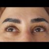 کاشت موقت و اکستنشن و لیفت