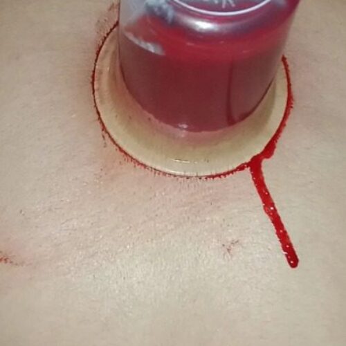 حجامت بادکش سم زدایی