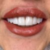 دندانپزشکی کامپوزیت ونیر طرح لبخند جرم گیری