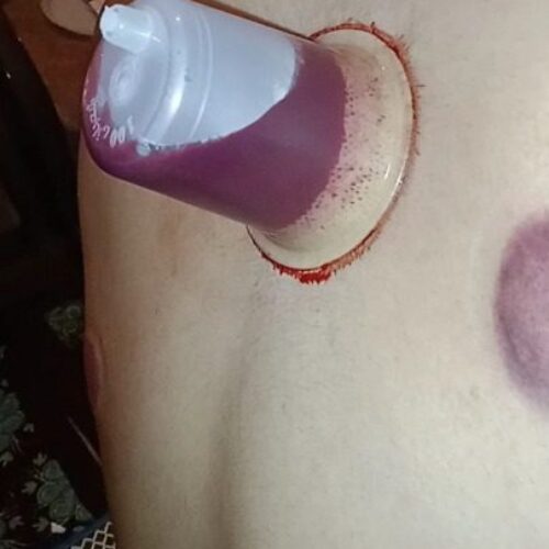 حجامت بادکش سم زدایی