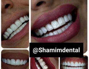 دندانپزشکی کامپوزیت ونیر طرح لبخند جرم گیری