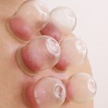 اموزش کلاس حجامت وفصدومزاج شناسی
