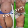 لیپوماتیک لاغری کاشت مو تزریق چربی ژل بوتاکس