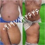 لیپوماتیک لاغری کاشت مو تزریق چربی ژل بوتاکس