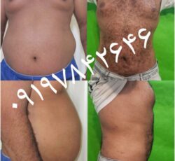 لیپوماتیک لاغری کاشت مو تزریق چربی ژل بوتاکس