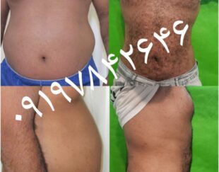 لیپوماتیک لاغری کاشت مو تزریق چربی ژل بوتاکس