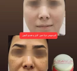 کرم ضد لک و سفید کننده دائمی