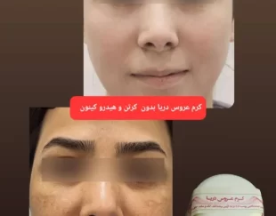 کرم ضد لک و سفید کننده دائمی