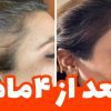 حجم دهی و فرم دهی سینه و باسن