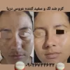 حجم دهی و فرم دهی سینه و باسن